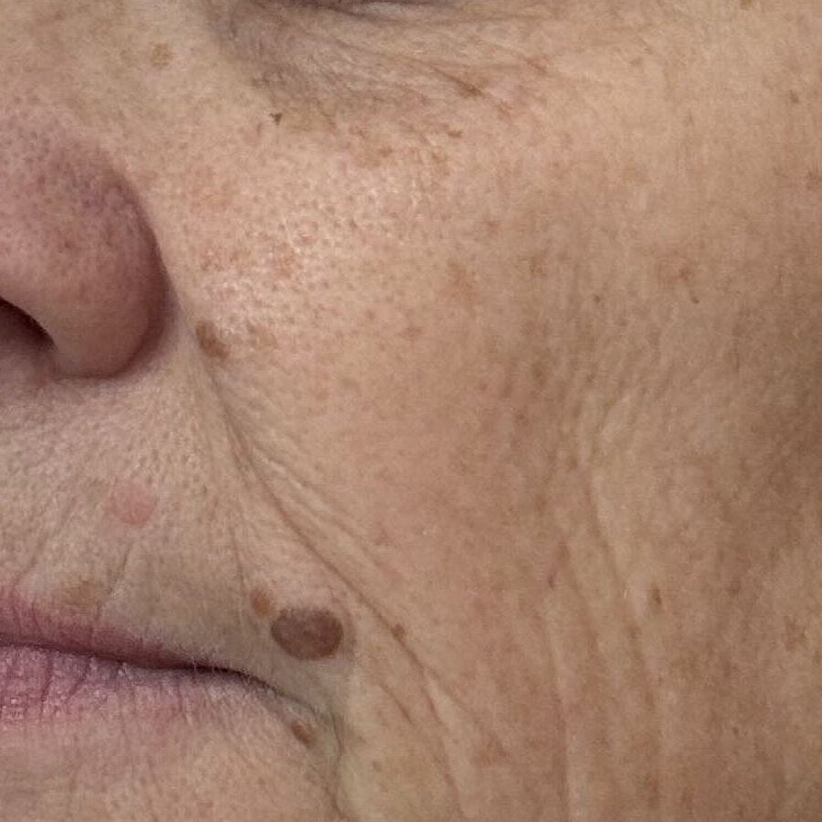 LEFT CHEEK before