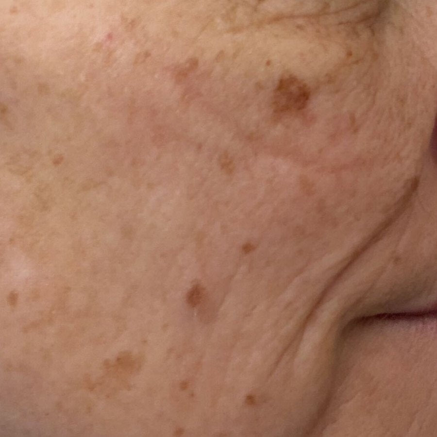 RIGHT CHEEK after