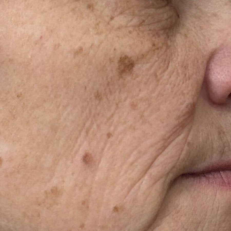 RIGHT CHEEK before
