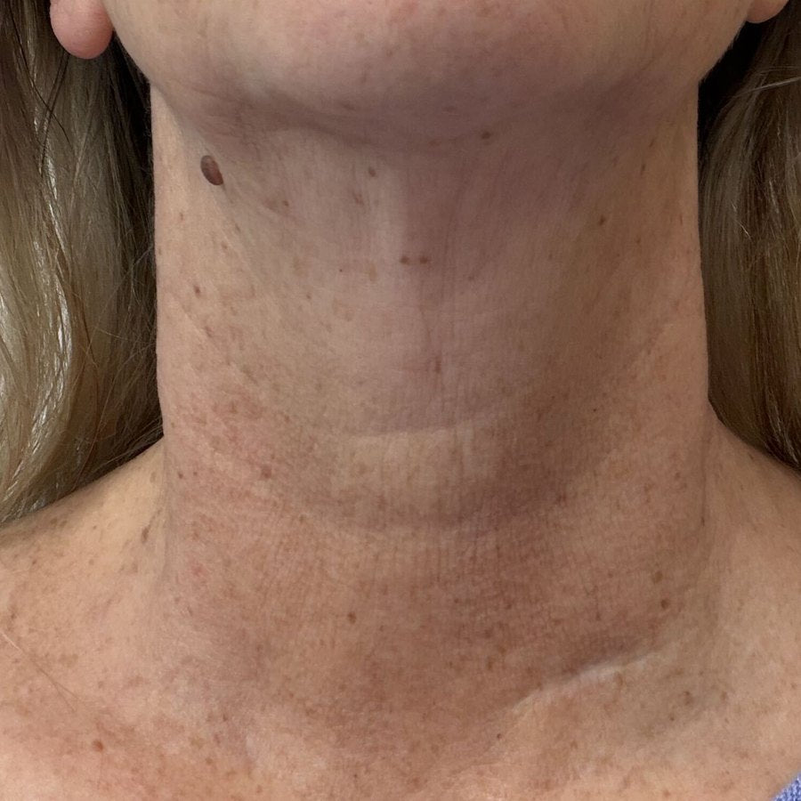 NECK after