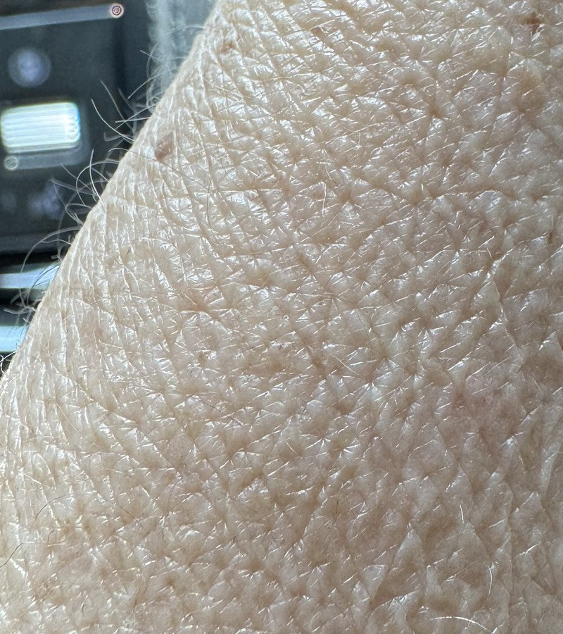 FOREARM before