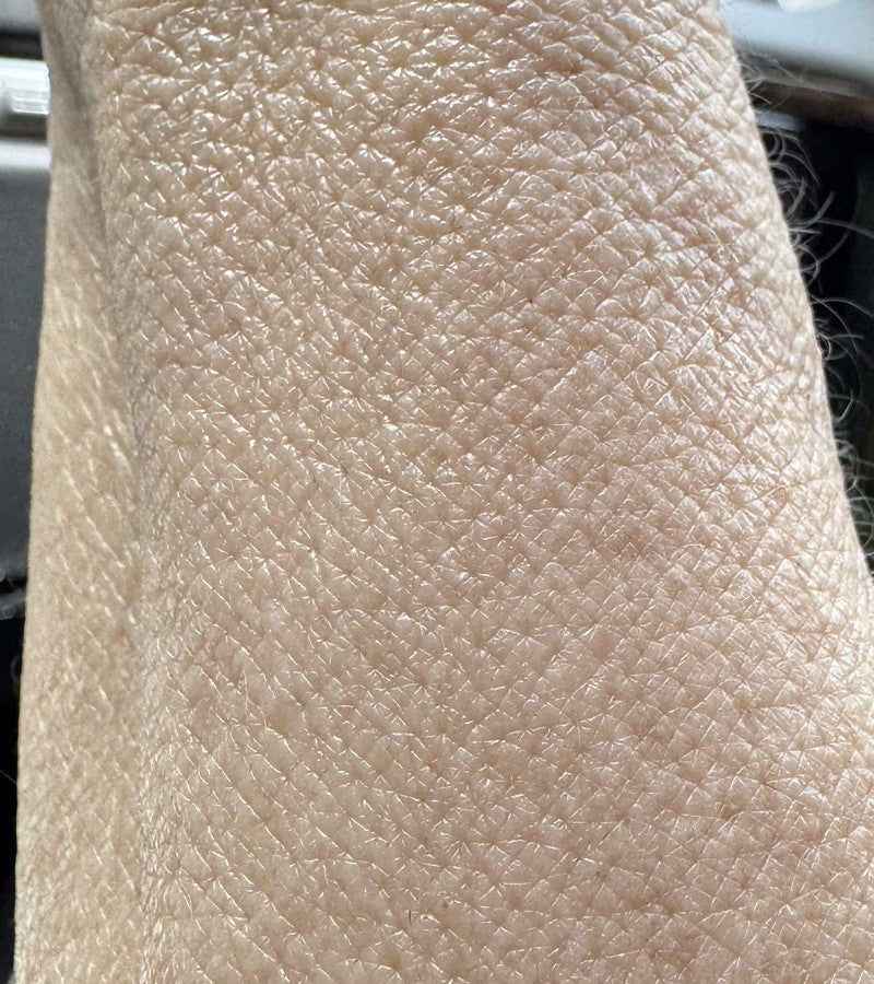 FOREARM after