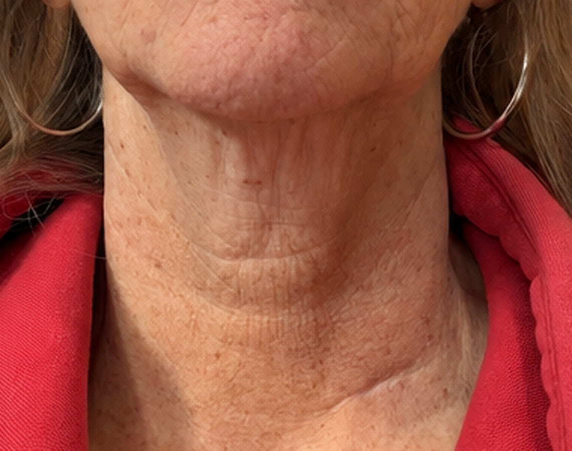 NECK after